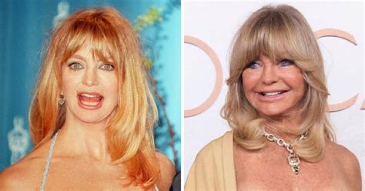 Plastic Surgery Speculations: Examining Goldie Hawn's Transformation