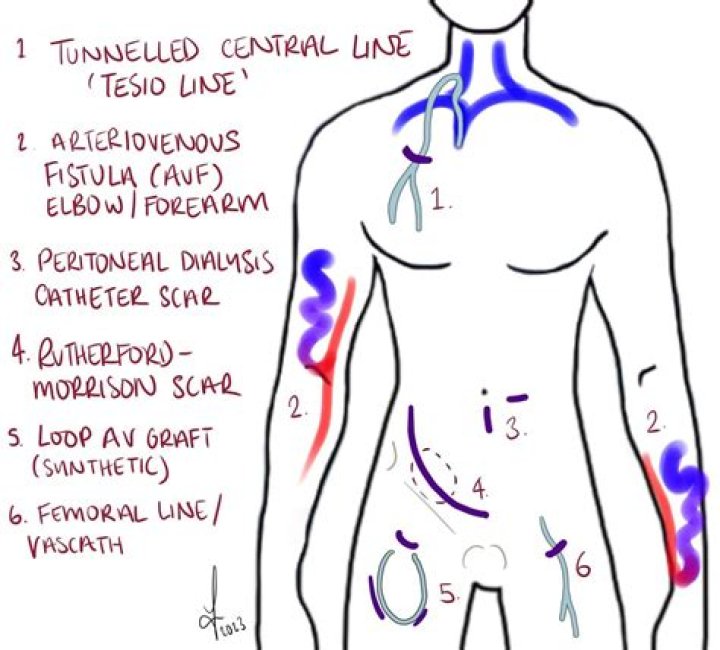 The Ultimate Guide To Understanding Kidney Operation Scars